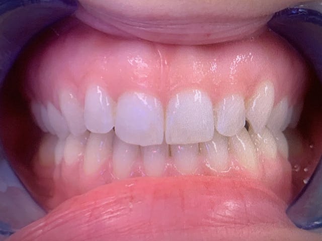 Nachher: Bei der ACC am Claraplatz Zahnklinik korrigieren wir deine Zähne. 