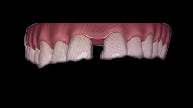 Vorher: Wenn die Lücke stört, kann die ACC am Claraplatz Zahnklinik auch das beheben.