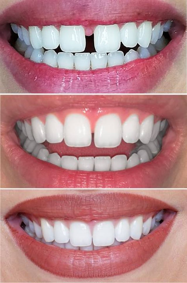 9 gouttières, 4,5 mois de traitement.