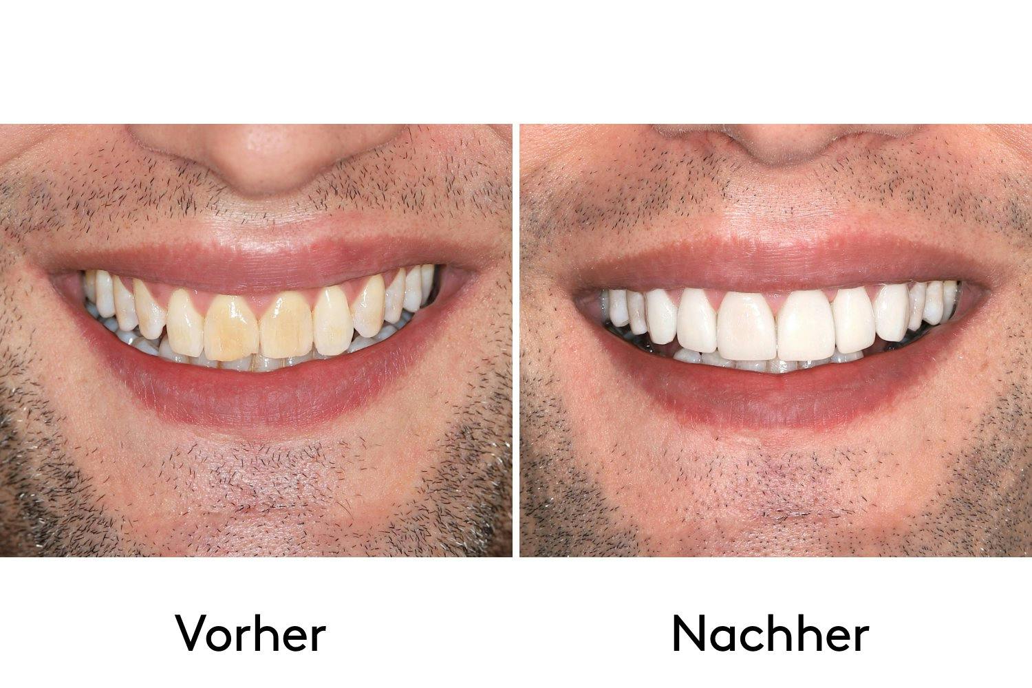 Veneers massgefertigte Keramikzähne für ein makelloses Lächeln 20 Minuten