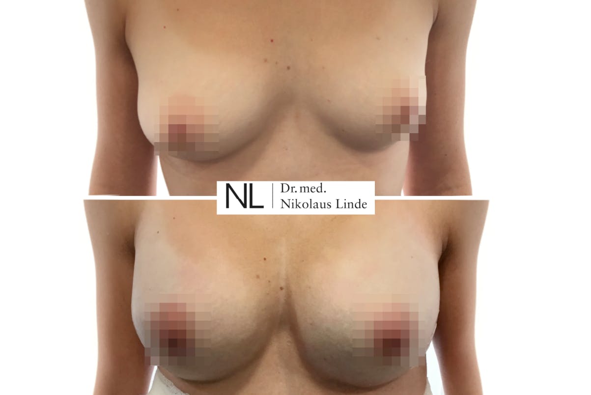 Dr. med. Nikolaus Linde arbeitet mit der BEAULI™-Methode, die das Eigenfett perfekt aufbereitet.