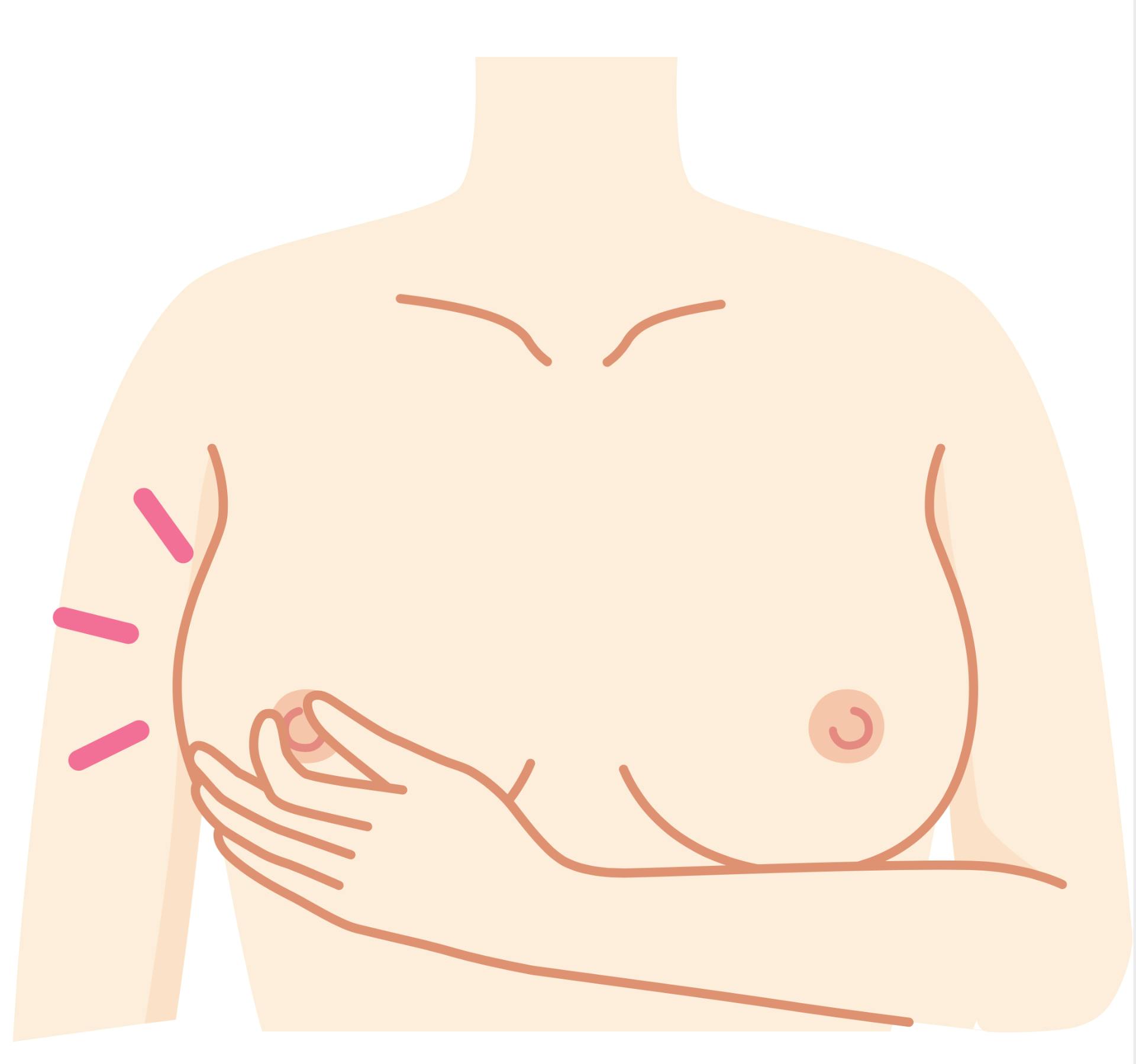 Tritt Flüssigkeit aus? Drücke die Brüste leicht mit den Händen zusammen und achte darauf, ob aus deinen Brustwarzen Flüssigkeit austritt.