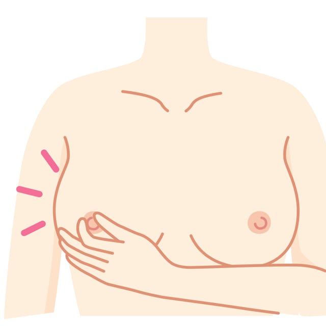 Tritt Flüssigkeit aus? Drücke die Brüste leicht mit den Händen zusammen und achte darauf, ob aus deinen Brustwarzen Flüssigkeit austritt. Tritt Flüssigkeit aus? Drücke die Brüste leicht mit den Händen zusammen und achte darauf, ob aus deinen Brustwarzen Flüssigkeit austritt.