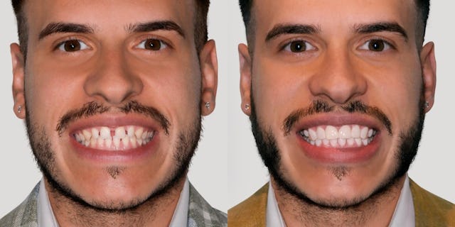 Mario avant et après son traitement bestsmile.