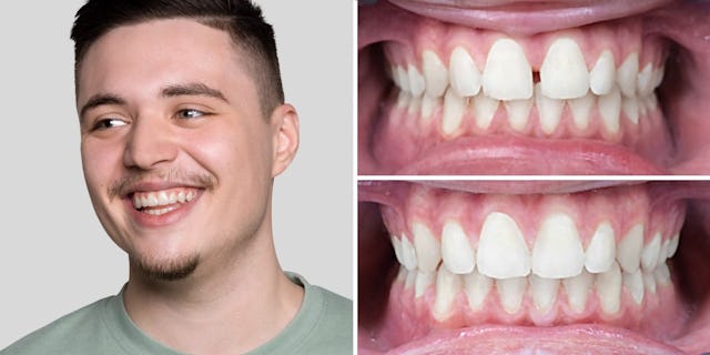 Pleura a gagné en confiance en lui, en se débarrassant de son espace interdentaire.