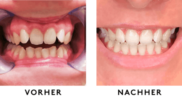 6 Monate, 12 Spangen