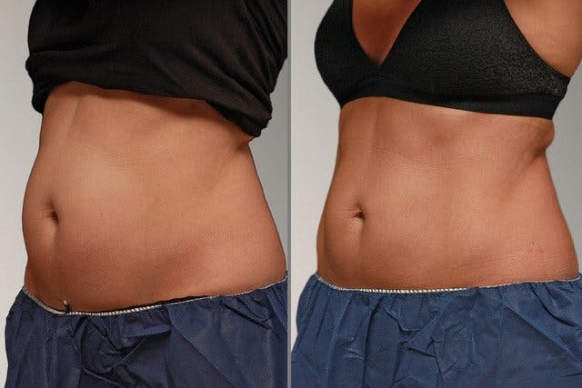 Bauch: Vor der Behandlung (links), nach der Behandlung (rechts).