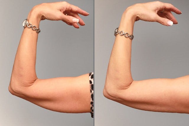 Oberarm: Vor der Behandlung (links), nach der Behandlung (rechts).