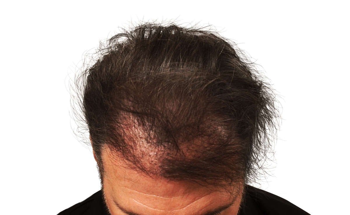 Vorher: von Haarausfall betroffene Kopfstellen.