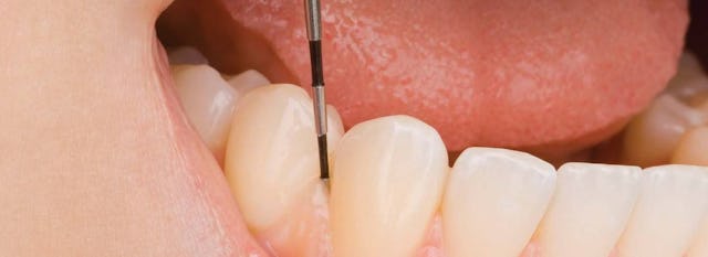 Die Taschenmessung mit der Parosonde sieht zwar gfürchig aus, tut aber praktisch nicht weh, und ist ein sehr wichtiges Diagnostikum um die Gesundheit des Zahnhalteapparates zu befunden.