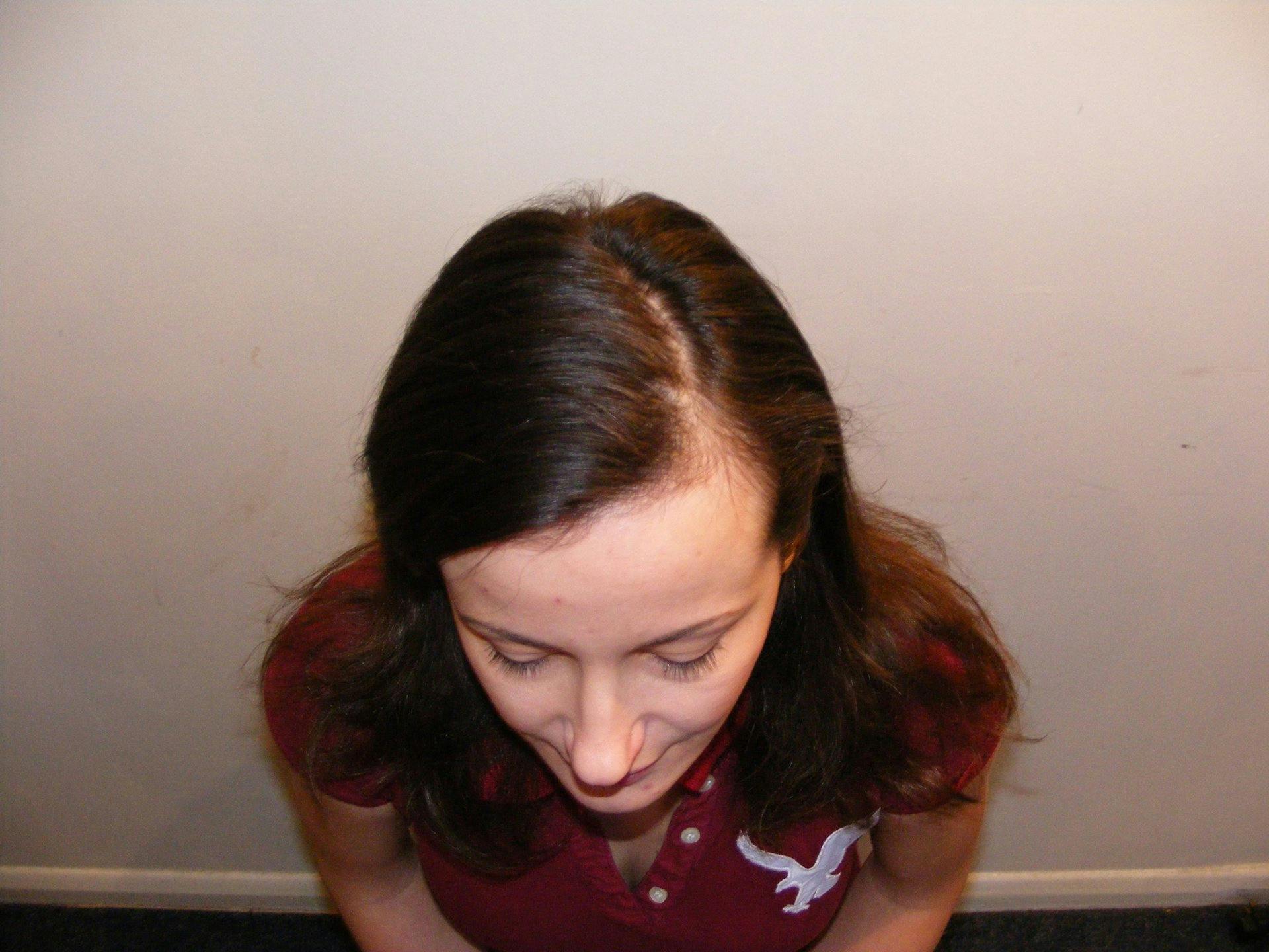 Vorher: die betroffenen, lichten Kopfstellen.