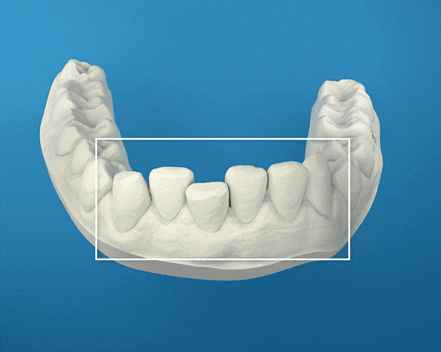 12 Spangen / 6 Monate Behandlungszeit