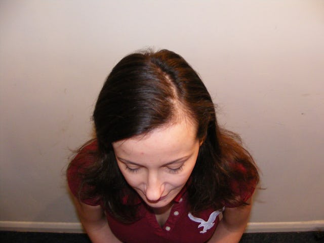 Vorher: die betroffenen, lichten Kopfstellen.