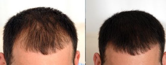 Lichte Haarstellen wie zum Beispiel an der Seite oder bei Geheimratsecken überdeckt der Mane Spray problemlos.