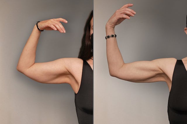 Oberarm: Vor der Behandlung (links), nach der Behandlung (rechts). Oberarm: Vor der Behandlung (links), nach der Behandlung (rechts).