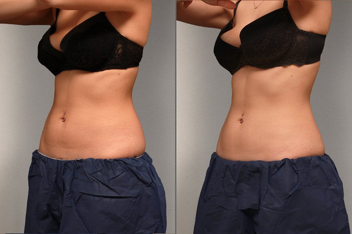 Bauch: Vor der Behandlung (links), nach der Behandlung (rechts).