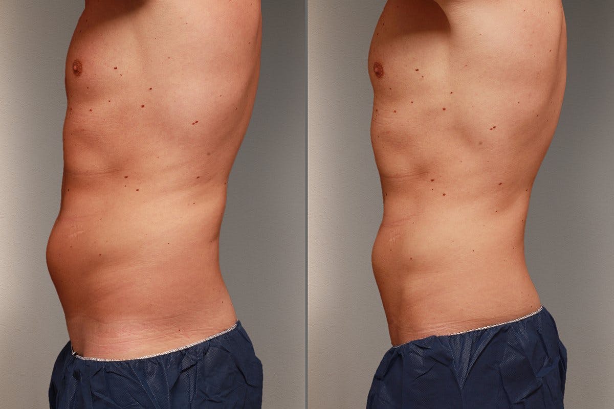 Bauch und Flanken: Vor der Behandlung (links), nach der Behandlung (rechts).