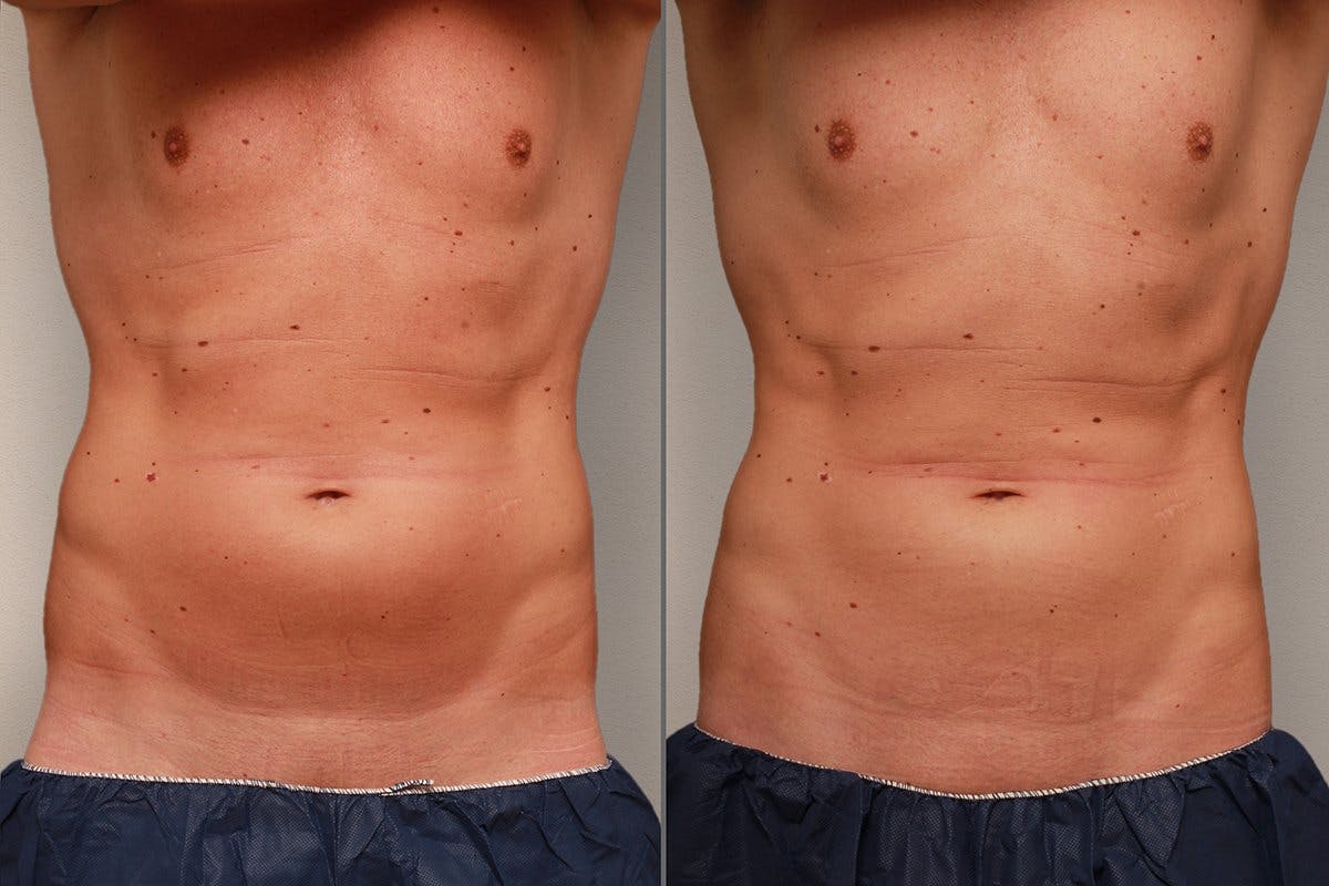 Bauch: Vor der Behandlung (links), nach der Behandlung (rechts).