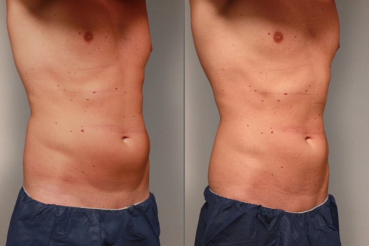 Flanken: Vor der Behandlung (links), nach der Behandlung (rechts).