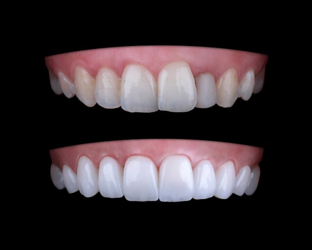 Veneers verschönern deine Zähne mit hauchdünnen Keramikplättchen.