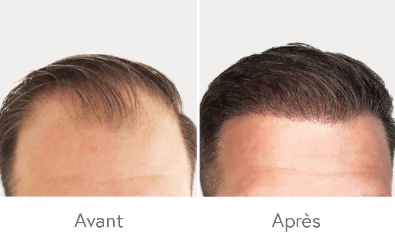 Des résultats impressionnants après une greffe de cheveux chez HAIR & SKIN.