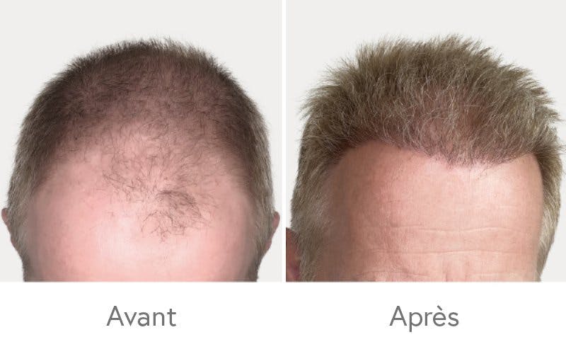 Des résultats impressionnants après une greffe de cheveux chez HAIR & SKIN.