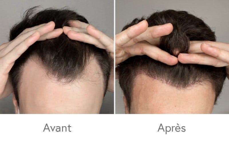 Des résultats impressionnants après une greffe de cheveux chez HAIR & SKIN.