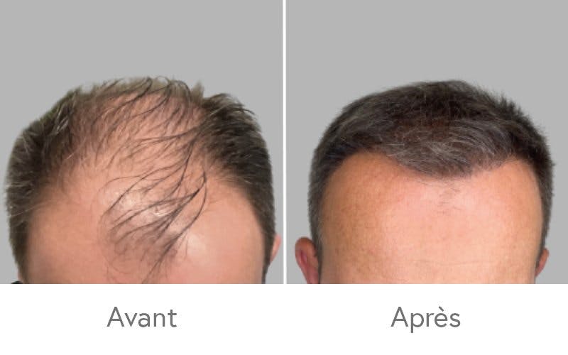 Des résultats impressionnants après une greffe de cheveux chez HAIR & SKIN.
