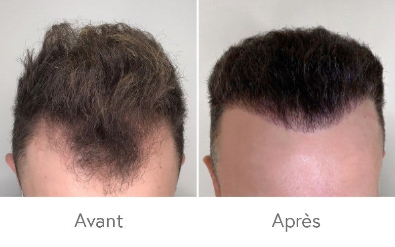 Des résultats impressionnants après une greffe de cheveux chez HAIR & SKIN.