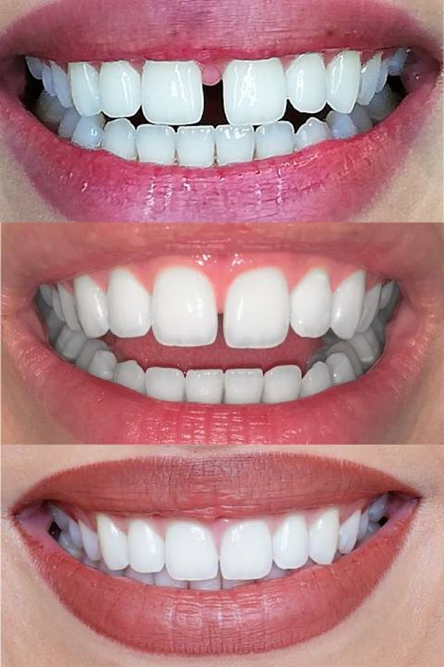 9 Spangen, 4,5 Monate Behandlungszeit