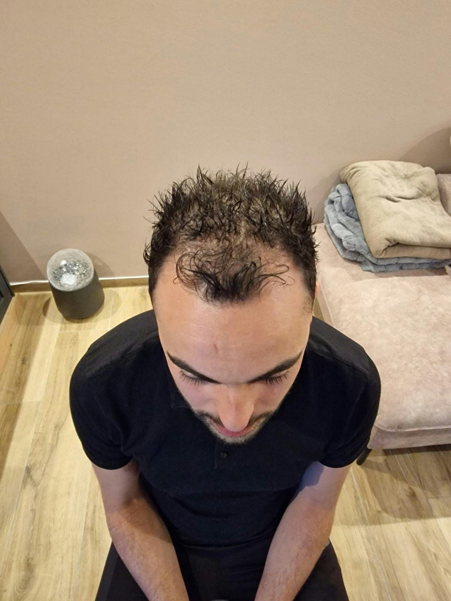 Vorher: von Haarausfall betroffene Kopfstellen.