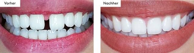 So kann auch dein Ergebnis mit einer bestsmile Zahnspange aussehen.