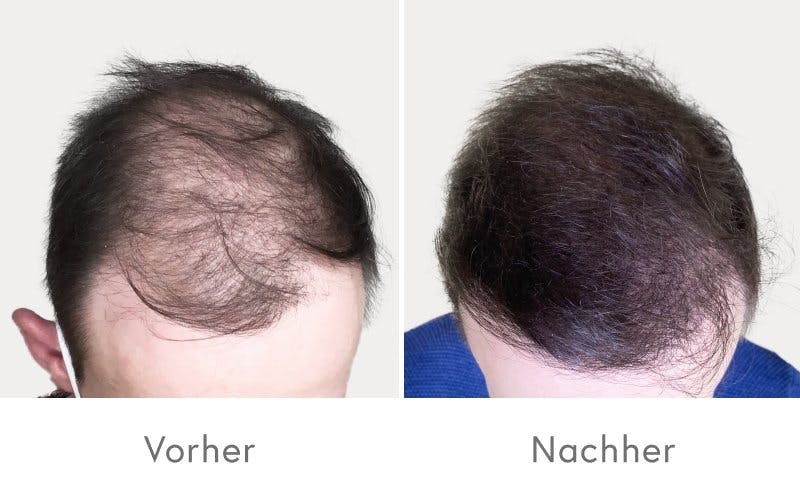 Auch eine PRP-Behandlung führt zu einer vollen Haarpracht.