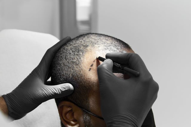 Die ersten Resultate einer Haartranasplantation sind nach rund drei Monaten zu sehen.