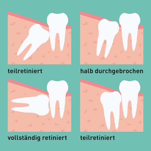 Teilretiniert oder vollständig retinierter Weisheitszahn: In der ABA Zahnklinik können alle solchen Zähne durch Fachleute entfernt werden.