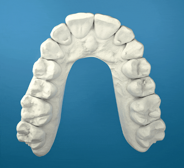 10 Spangen / 5 Monate Behandlungszeit