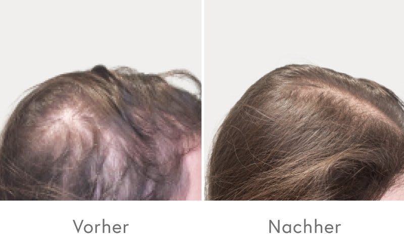 Einfach und effektiv zu vollerem Haar.