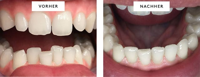 Zwölf Schienen, sechs Monate Behandlungszeit