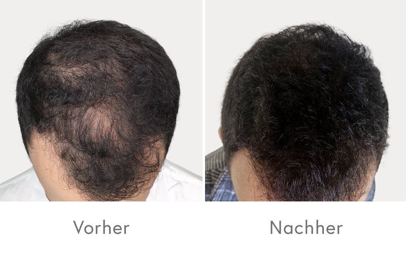 Effektive Ergebnisse nach vier PRP-Behandlungen.