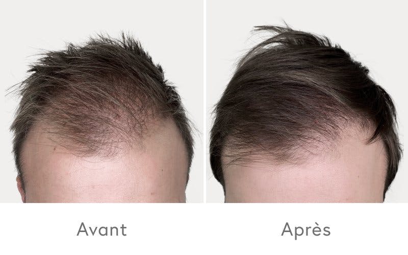 Résultat après quatre traitements PRP.