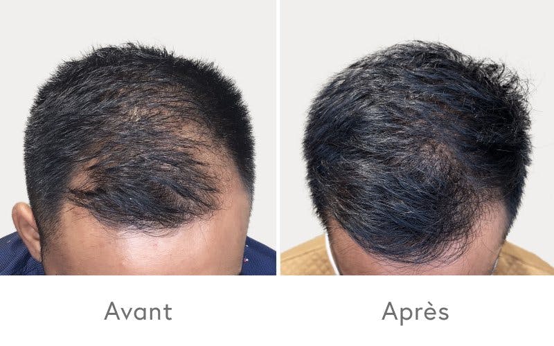 Résultat après quatre traitements PRP.