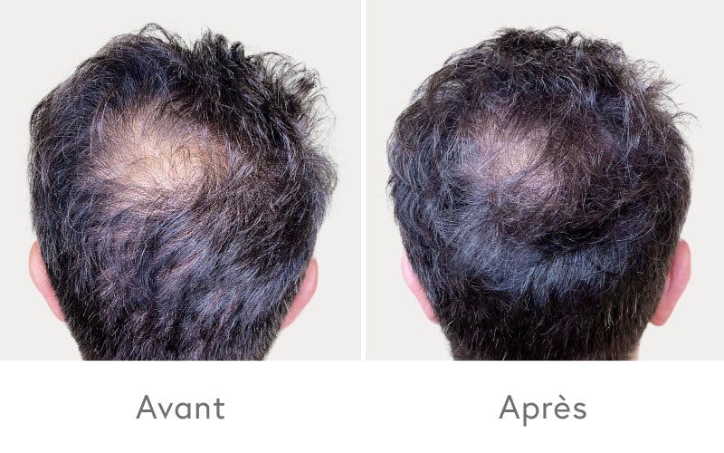 Résultat après quatre traitements PRP.