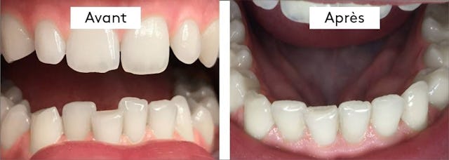 12 gouttières, 6 mois de traitement.