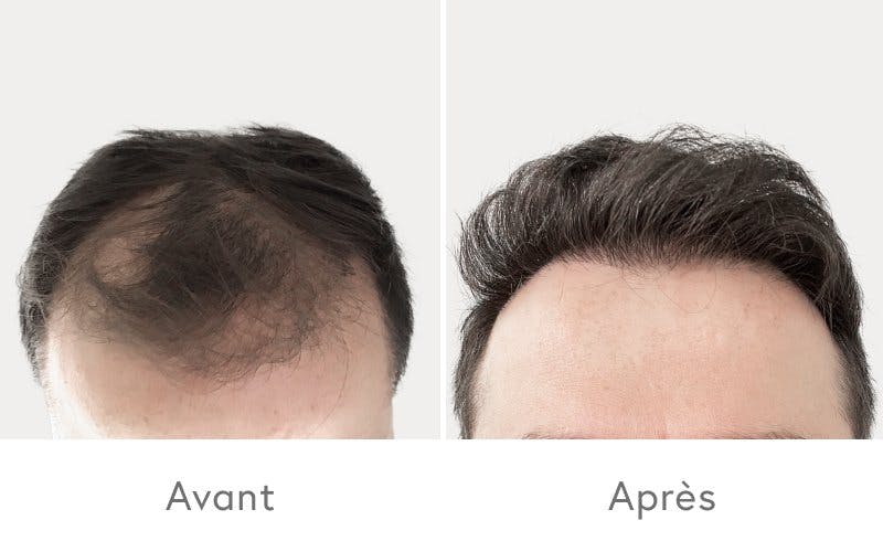 Une nette amélioration suite à une transplantation capillaire chez HAIR & SKIN