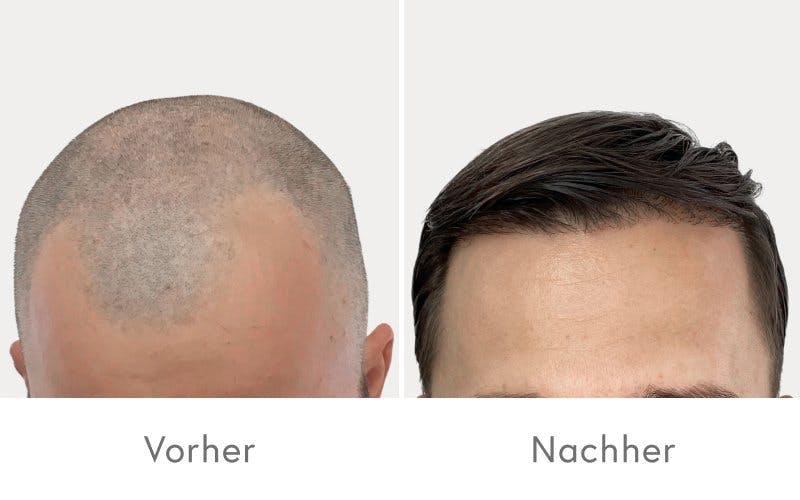 Überzeugende Ergebnisse nach einer Haartransplantation bei HAIR & SKIN