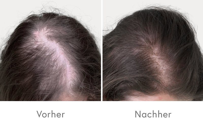 Eindrucksvolle Ergebnisse nach vier PRP-Behandlungen