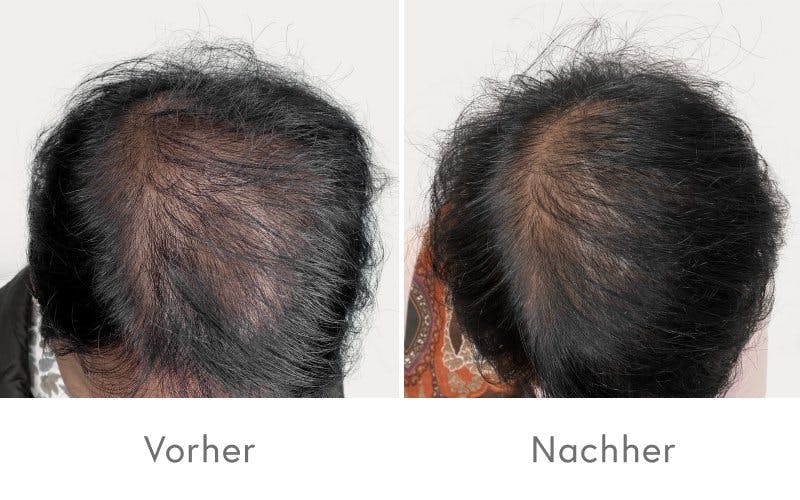 Eindrucksvolle Ergebnisse nach vier PRP-Behandlungen