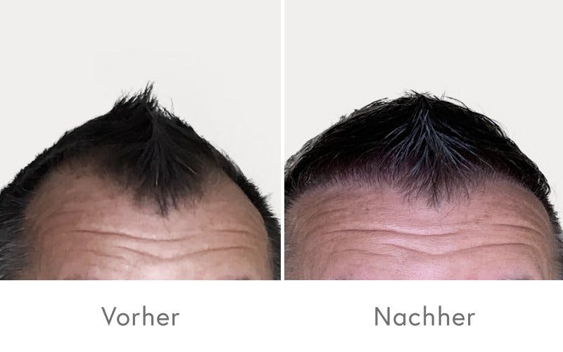 Beeindruckende Ergebnisse nach einer Haartransplantation bei HAIR & SKIN.