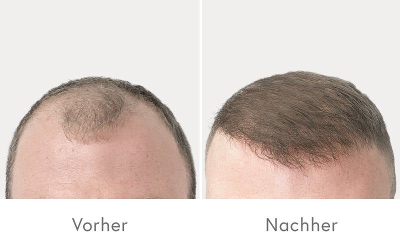 Beeindruckende Ergebnisse nach einer Haartransplantation bei HAIR & SKIN.