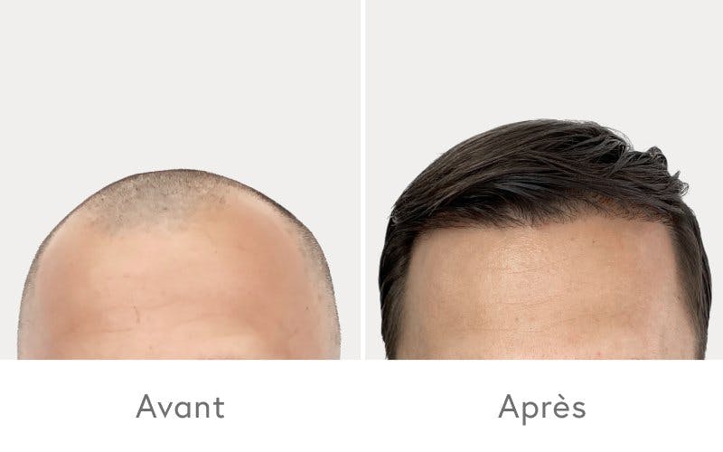 Des résultats impressionnants après une greffe de cheveux chez HAIR & SKIN